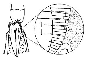 abfraction