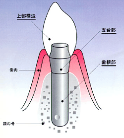 インプラント