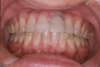 前歯の破折症例1