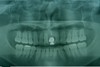 前歯の破折症例2