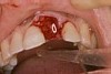 前歯の破折症例3