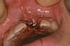 前歯の破折症例5