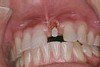 前歯の破折症例6