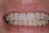 前歯の破折症例7